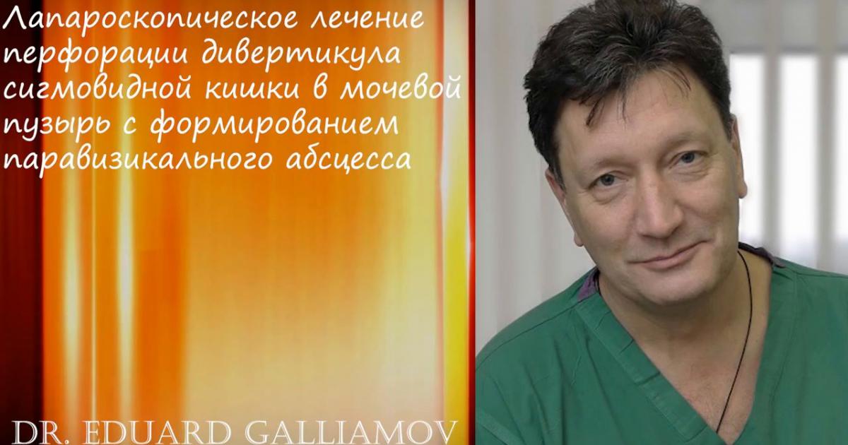 Лапароскопическое лечение перфорации дивертикула сигмовидной кишки в ...