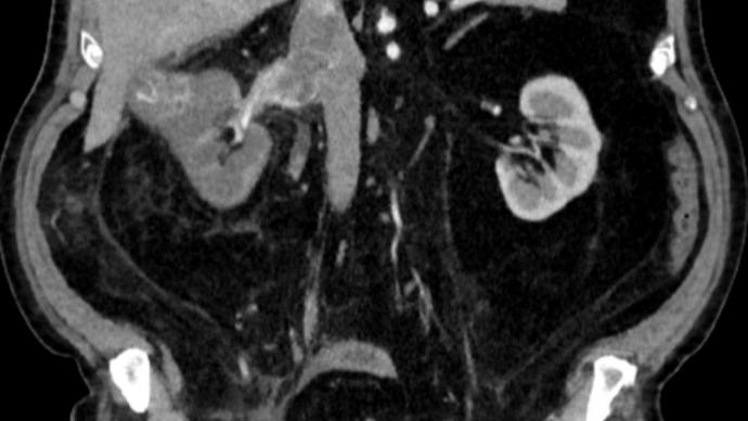 Онлайн-трансляция "Уникальная операция удаления тромба из нижней полой вены"