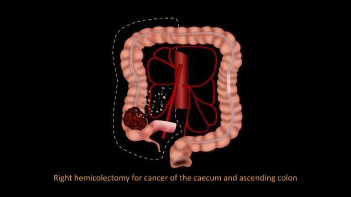Optimised Colon Cancer Treatment - Тотальная мезоректумэктомия. Хирургическая техника.