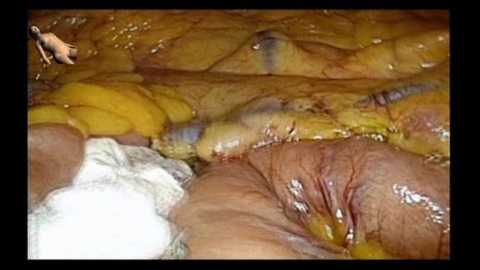 Optimised Colon Cancer Treatment - лапароскопическая левосторонняя гемиколэктомия по поводу рака селезеночного изгиба ободочной кишки