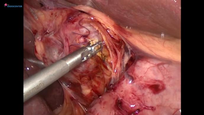 Laparoscopic choledoholitotomy&IPOM hernia repair LIVE