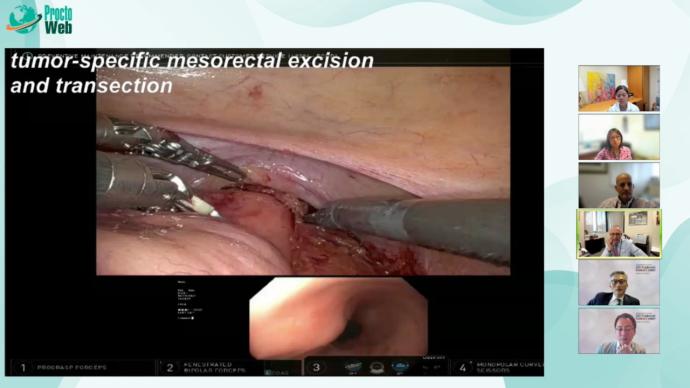 Julio Garcia-Aguilar - Tumor-specific mesorectal excision and transection