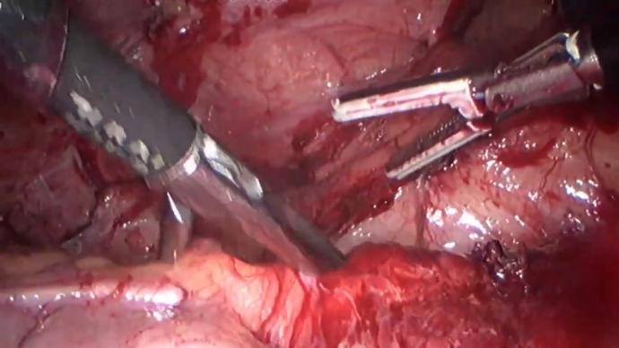 LaparoscopIc intestinal ureteroplasty LIVE