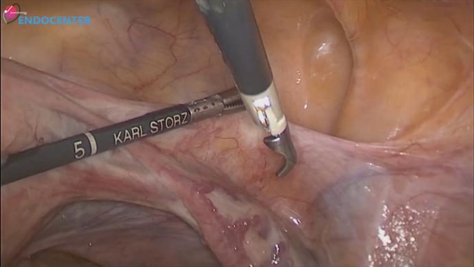 Laparoscopic hysterectomy LIVE