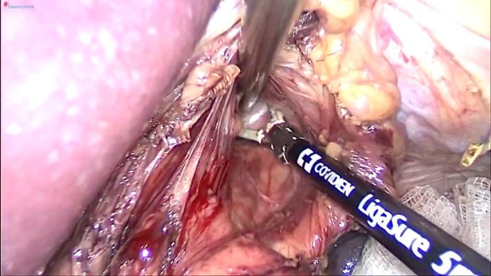 Laparoscopic oesophaeal diverticulus removal