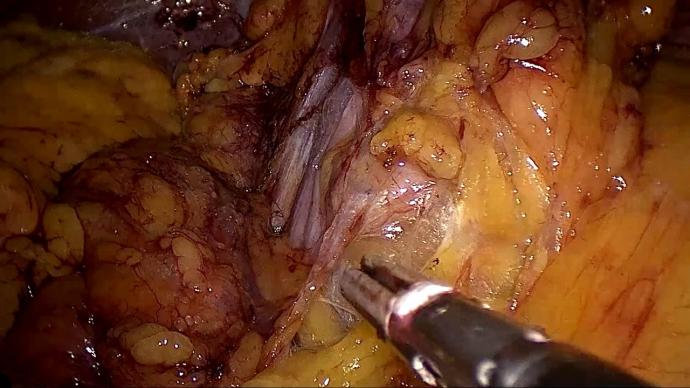 LaparoscopIc pancreatoduodenectomy (Whipple procedure) LIVE