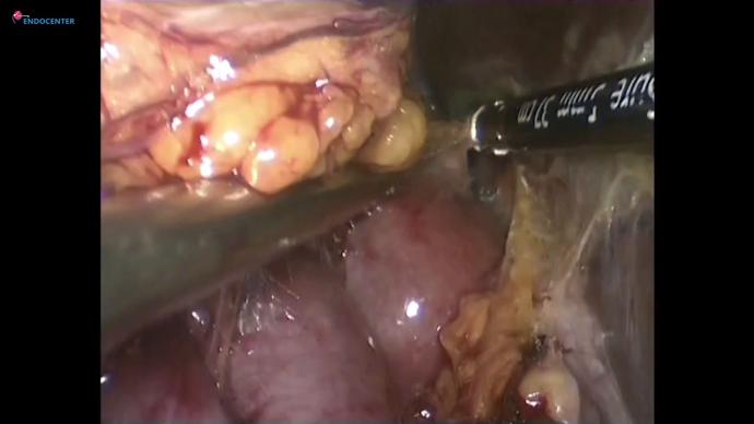 Laparoscopic partial nephrectomy Huge hilar_ Резекция почки в воротах RENAL 12