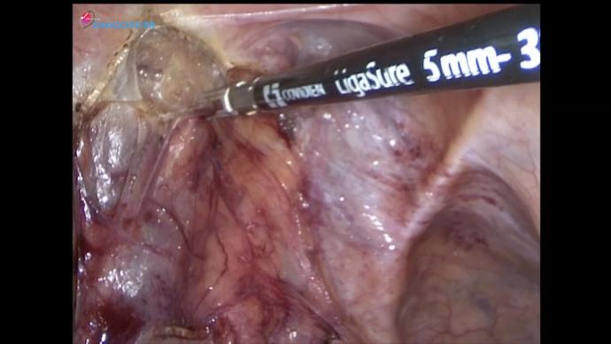 Laparoscopic radical cystectomy, aorto pelvic LND, Bricker _ Цистэктомия