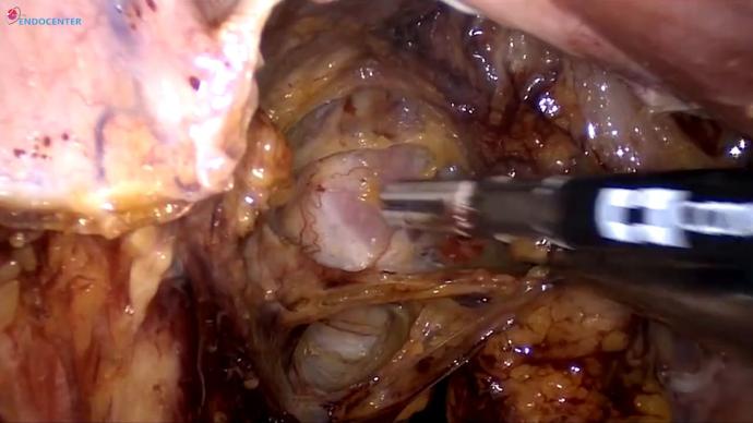 Laparoscopic radical hysterectomy, pelvic LND _ Радикальная гистерэктомия с тазо