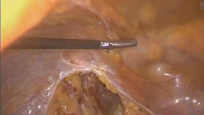 Laparoscopic radical hysterectomy with aorto pelvic LND _Радикальная гистерэктом