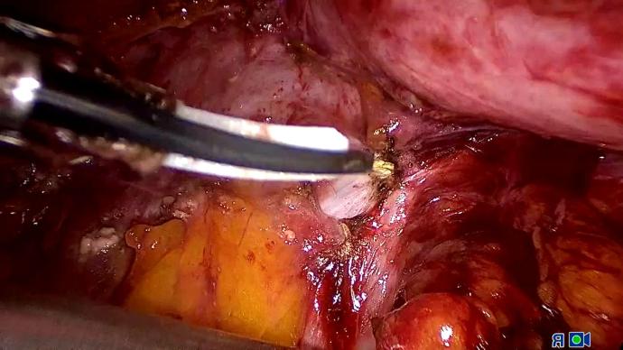 Laparoscopic rectovaginal fistula repair LIVE _ Разобщение ректовагинального свища