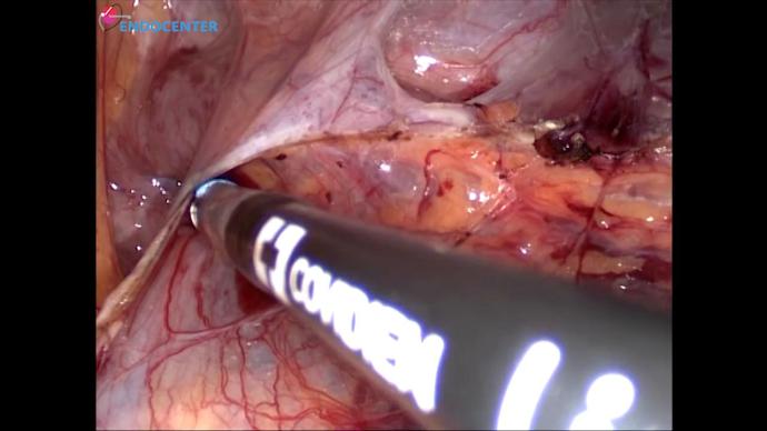 Laparoscopic right ileal ureter replacement substitution  Кишечная пластика мочеточника
