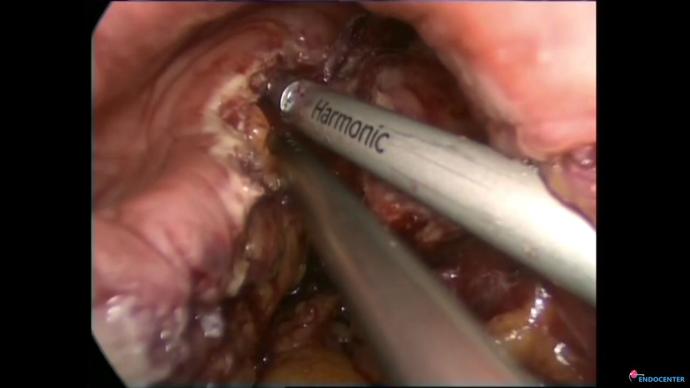Laparoscopic uretrorectal fistula repair. Разобщение уретро ректального свища