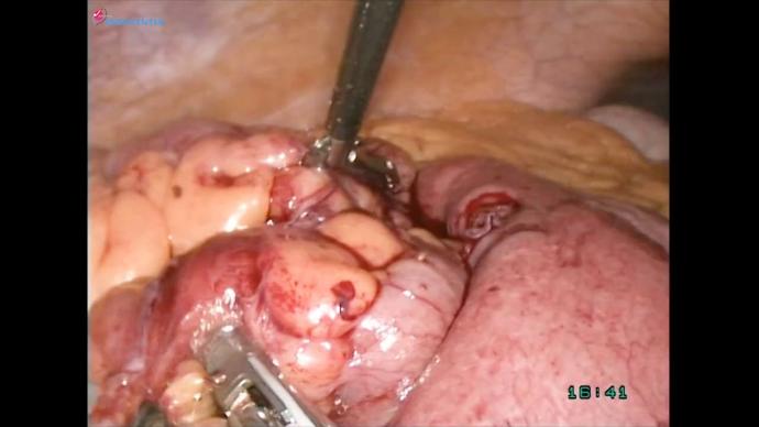 Laparoscopic urgent intestinal resection LIVE _ Crohne disease acute intestinal