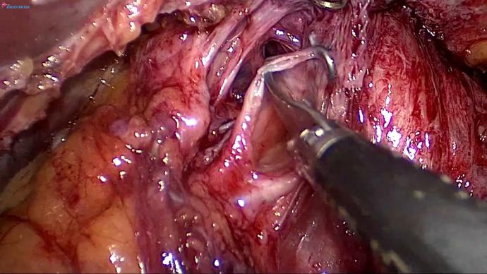 LIVE Laparoscopic ReDo hiatal hernia after Mesh&Collis. Лапароскопическое повторное удаление грыжи пищеводного отверстия диафрагмы.
