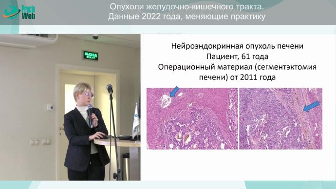 Мороз Е.А. - Итоги года, новые возможности в патоморфологической диагностике опухолей ЖКТ