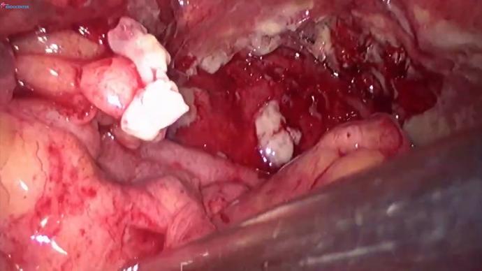 Relaparoscopy 15 POD after Bricker cystectomy LIVE. Релапароскопия через 15 дней после цистэктомии Брикера.