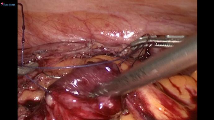 Second stage intestinal ureteroplasty 6 months later. Второй этап кишечной уретеропластики через 6 месяцев.