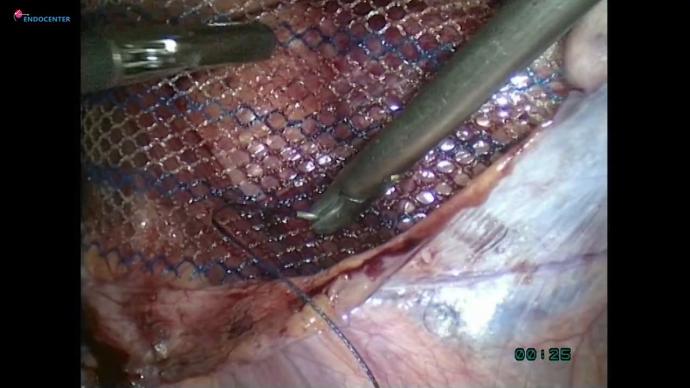 TAPP, intracorpoeal suturing ficsation. TAPP, фиксация внутрикорпоральных швов
