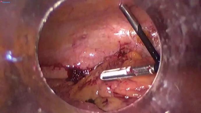 Total pelvic exenteration &left hemycoleciomy LIVE. Тотальная экзентерация таза и гемиколэктомия слева.