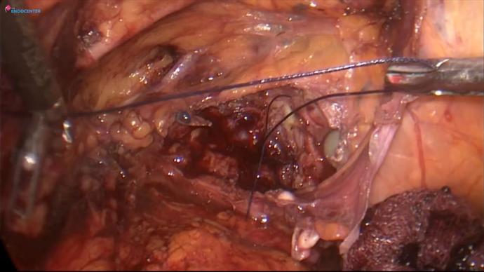 Ureterectomy single kidney (1step). Удаление мочеточника единственной почки.