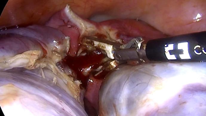 Галлямов Э.А - Laparoscopic giant ovarian tumor, panhyster & omentectomy / Понгистерэктомия, оментэктомия