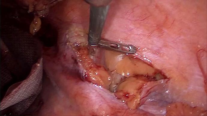 Галлямов Э.А - Reccurent perineal hernia LIVE / Лапароскопическая рецидивная грыжа промежности после открытой БПЭ
