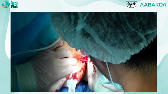 Маркарьян Д.Р. - Операция 2. Оперативное лечение геморроя, свищей прямой кишки, ректоцеле.