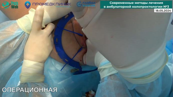 Маркарьян Д.Р.- Ректоцеле. Оперативное лечение. Задняя кольпомиоррафия. 