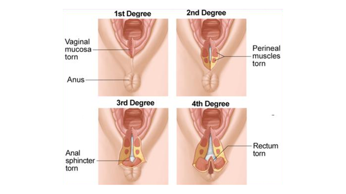 Данные 2025 года. Факторы риска раневых осложнений после акушерской травмы анального сфинктера (OASI)