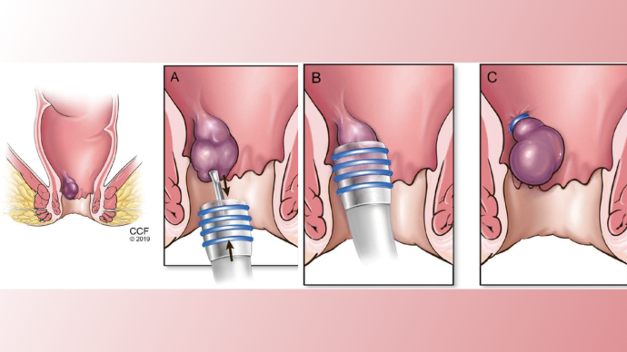 Глобальные подходы к лечению геморроя: результаты международного аудита ISUCRS