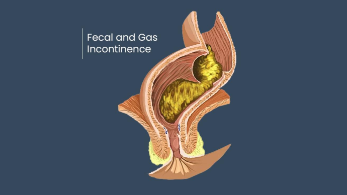 Современные дискуссии в лечении недержания кала