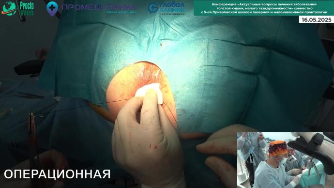 Толстых В.С. - Дезартеризация геморроидальных узлов с лифтингом слизистой