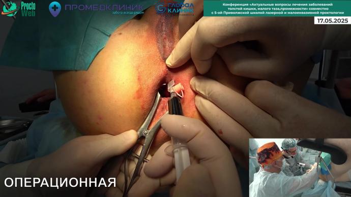 Башкуров О.Е. - Иссечение свища прямой кишки