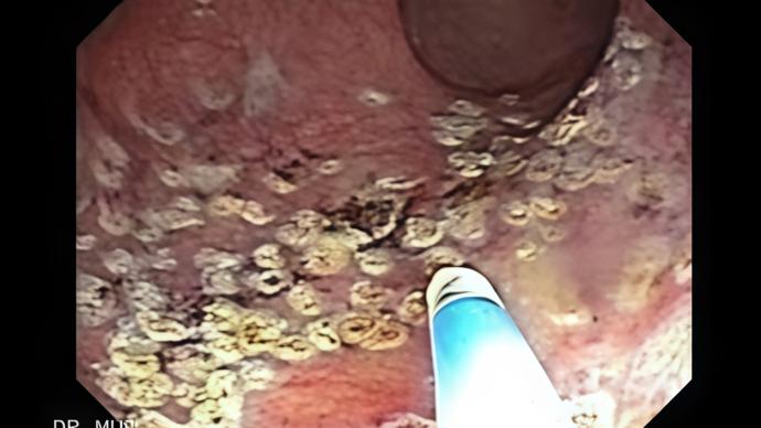 Постлучевой проктит. БЕЗ РЕКЛАМЫ.  