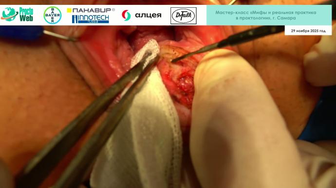 Маркарьян Д.Р. - Оперативное лечение ректовагинального свища