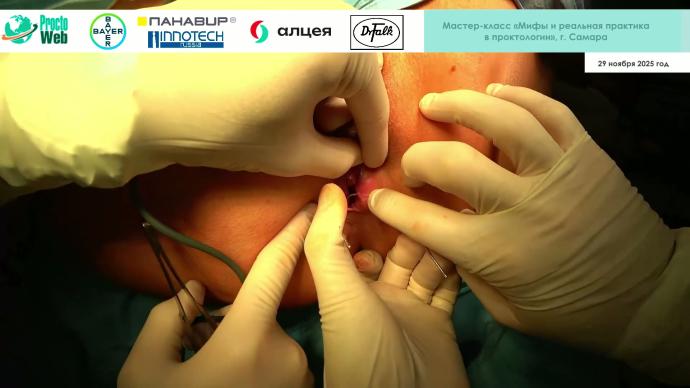 Маркарьян Д.Р. - Оперативное лечение свища анального канала