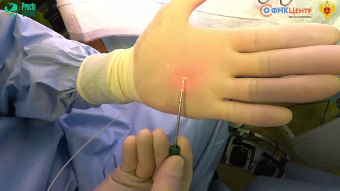 Таривердиев А.М. - Осложнения при лечении геморроидальной болезни и их лечение