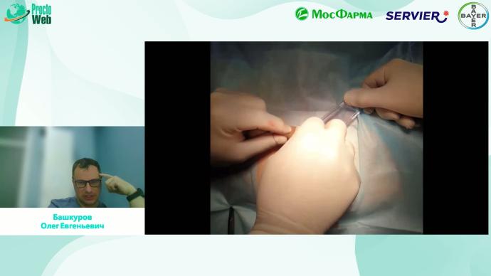 Башкуров О.Е. - Как я оперирую геморрой