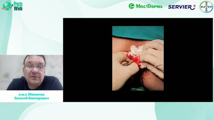 Можанов Е.В. - Как я оперирую геморрой