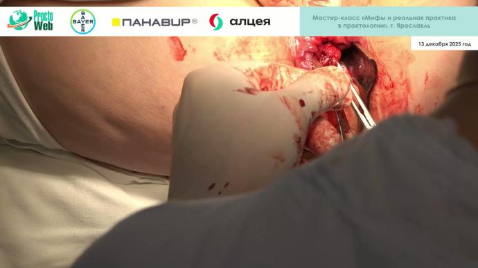 Маркарьян Д.Р. - Открытая и закрытая геморроидэктомия