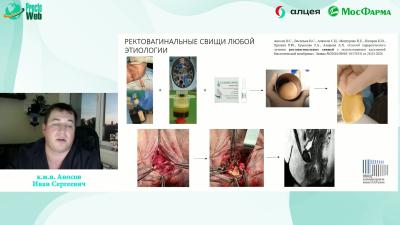 Аносов И.С. - Лечение ректовагинальных свищей с применением аутологичного биоматериала
