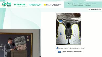 Филистеев П.А. - МРТ-навигация свищей прямой кишки