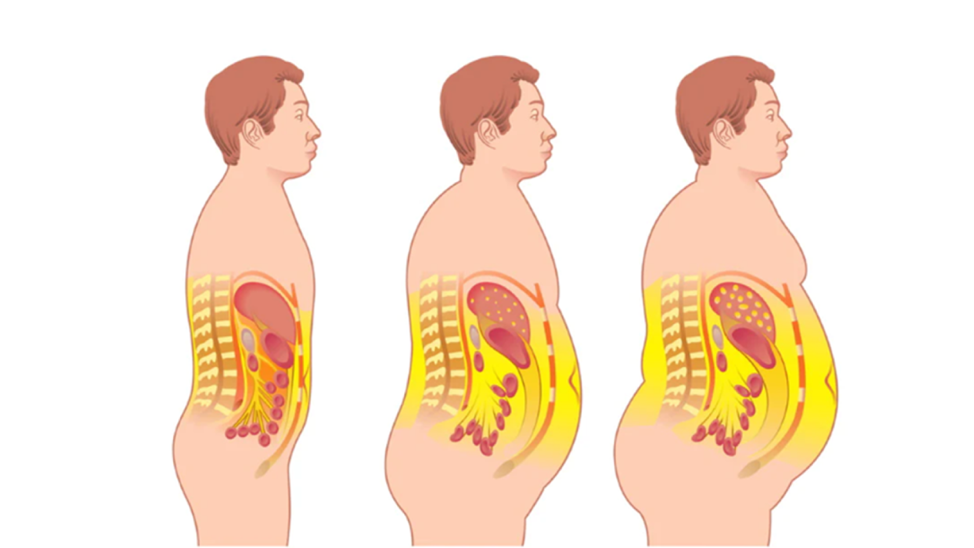 Висцеральное ожирение & ИМТ как предикторы рецидива ВЗК
